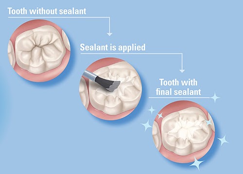 Doctor Staci Talks Sealants in a guest blog for Ask the Dentist!